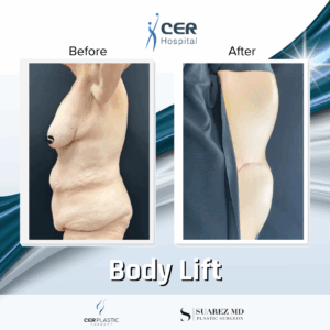 Body Lift – 075