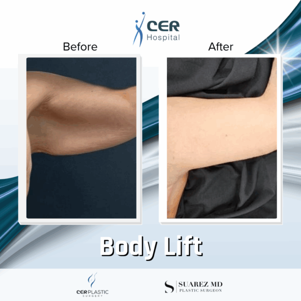 Body Lift - 304 - Image 8