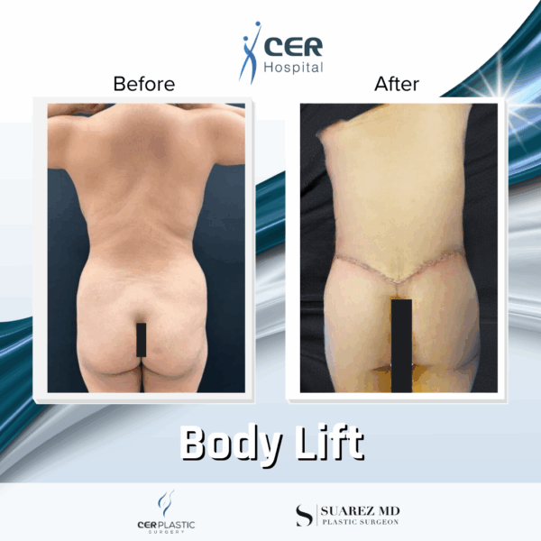 Body Lift - 234 - Image 9