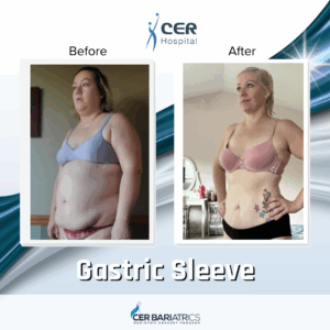 Gastric Sleeve