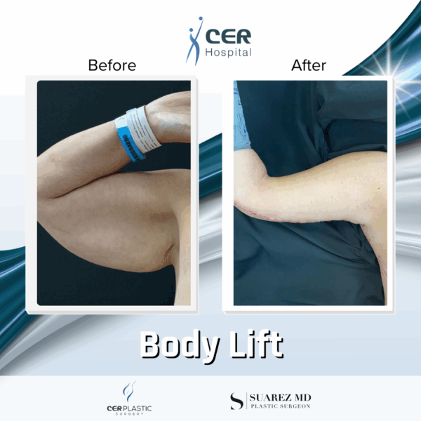 Body Lift -2094 - Image 9