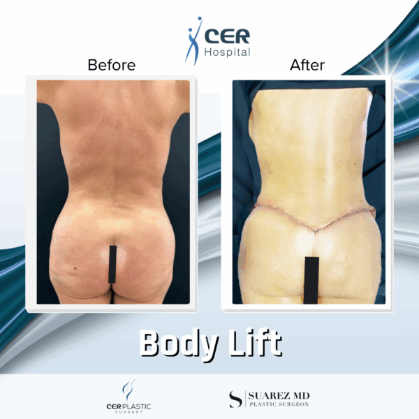 Body Lift -7104 - Image 9