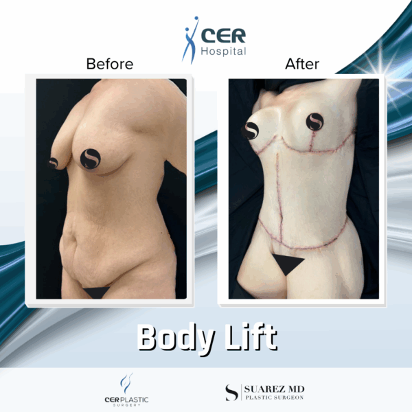 Body Lift - 26064 - Image 8