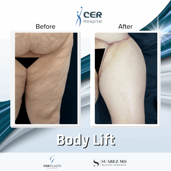 Body Lift - 17064 - Image 8