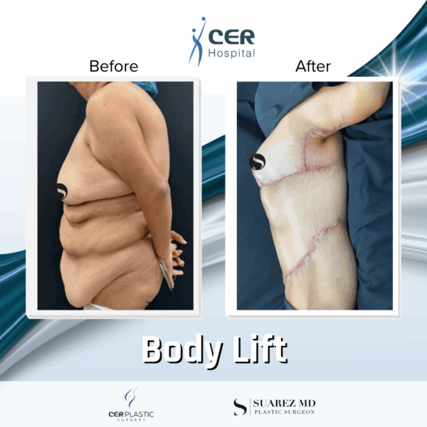 Body Lift -14064 - Image 8