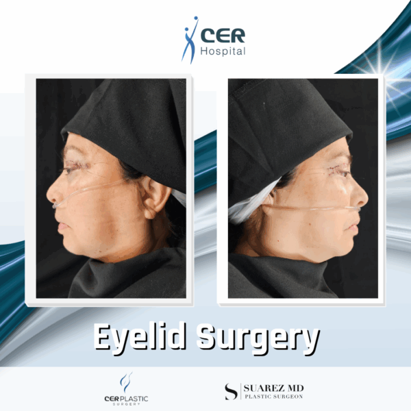 Body Lift and Eyelid Surgery - 5064 - Image 8