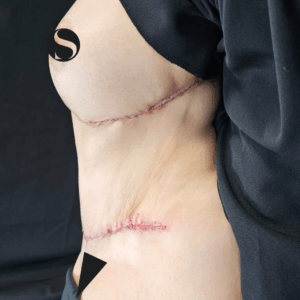 Body Lift and Eyelid Surgery – 5064