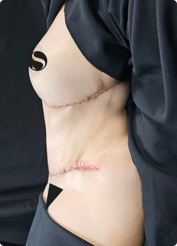 Body Lift and Eyelid Surgery - 5064 - Image 2