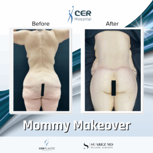 Mommy Makeover – 311