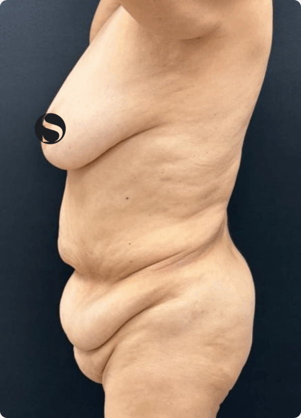 Semi Circular Tummy Tuck - 3064 - Image 3