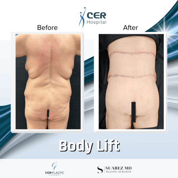 Body Lift - 20054 - Image 9