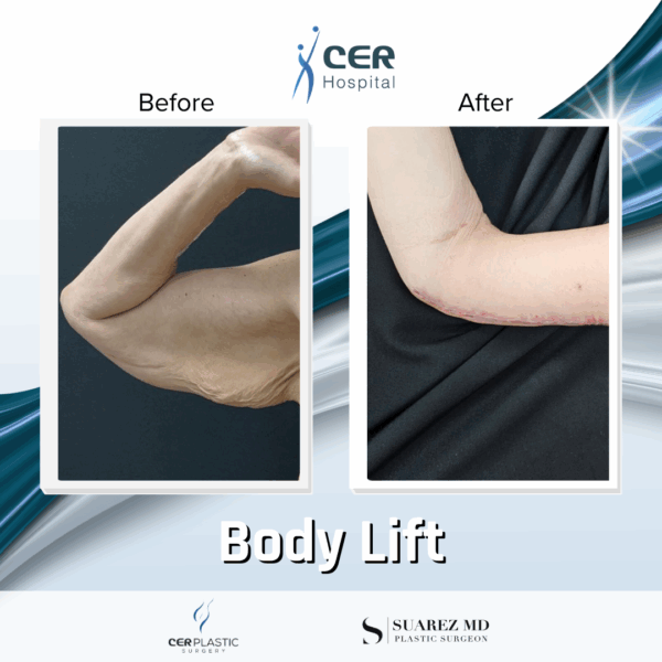 Body Lift - 17054 - Image 8