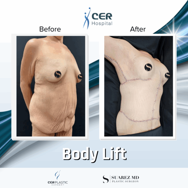 Body Lift - 8054 - Image 9
