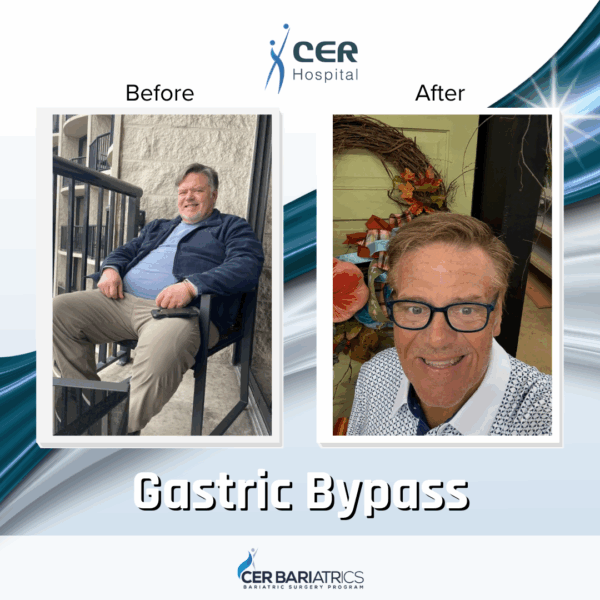 Gastric Bypass - Image 8