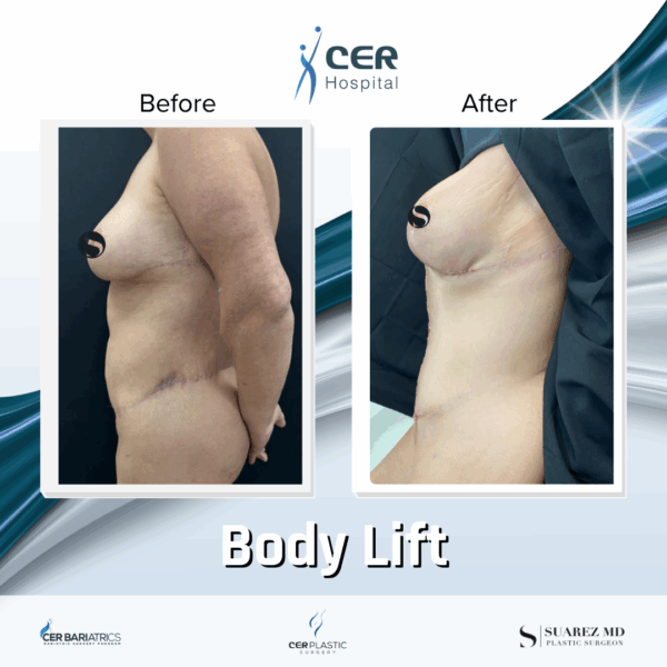 Body Lift - 243 - Image 8