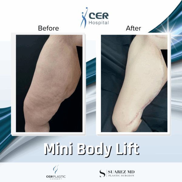 Body Lift - 094 - Image 8