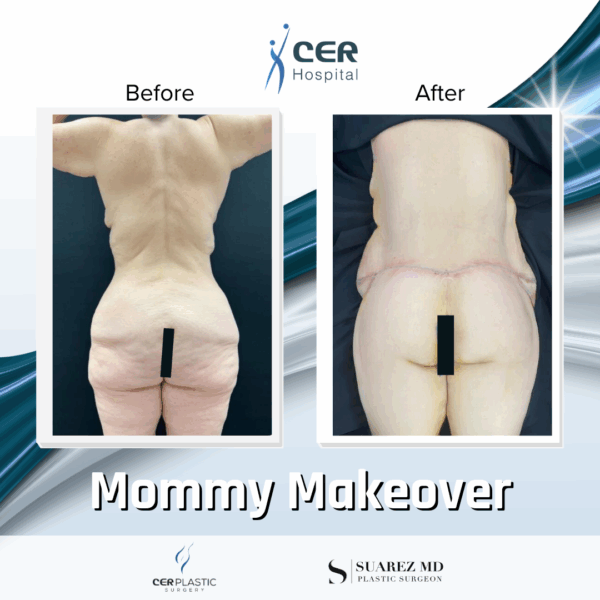 Mommy Makeover - 311