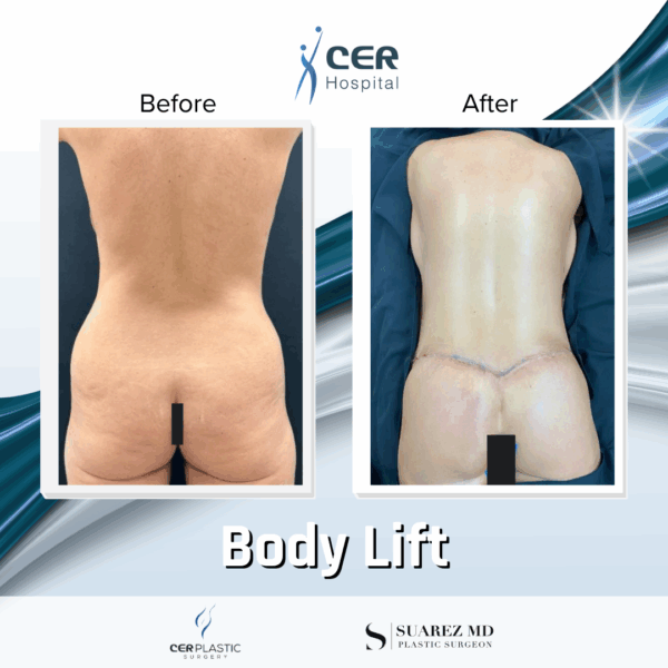 Body Lift - 125 - Image 9