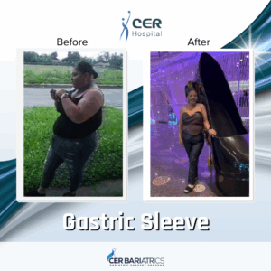 Gastric Sleeve