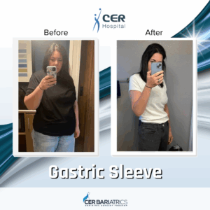 Gastric Sleeve