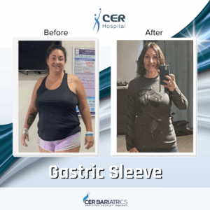 Gastric Sleeve