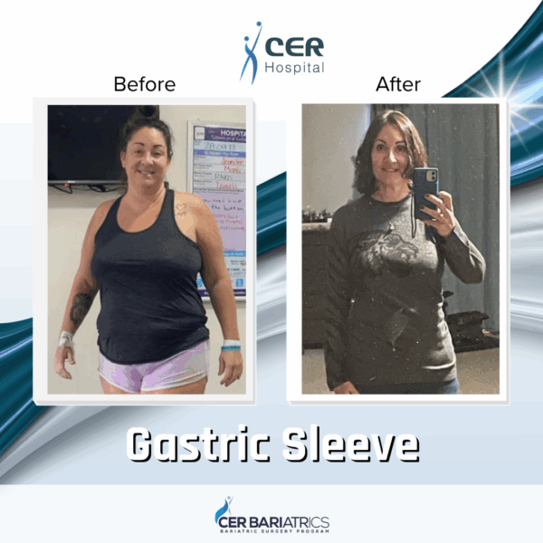 Gastric Sleeve