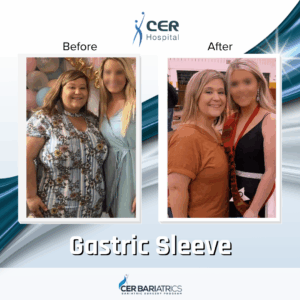 Gastric Sleeve