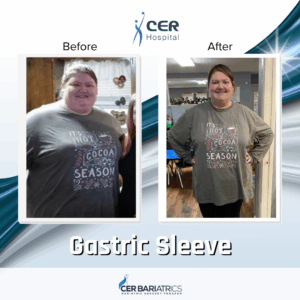 Gastric Sleeve