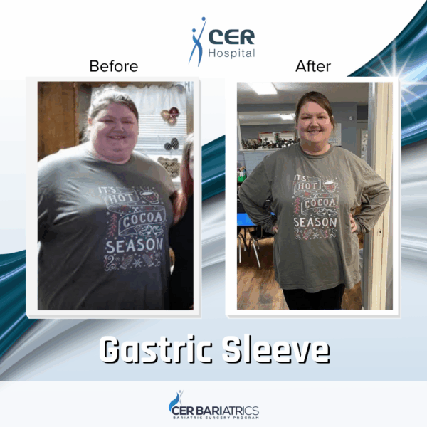 Gastric Sleeve