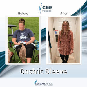 Gastric Sleeve