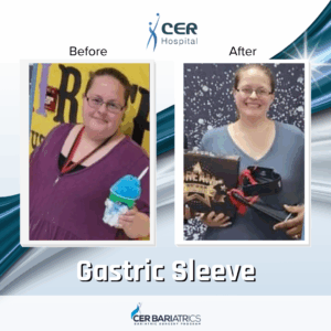 Gastric Sleeve