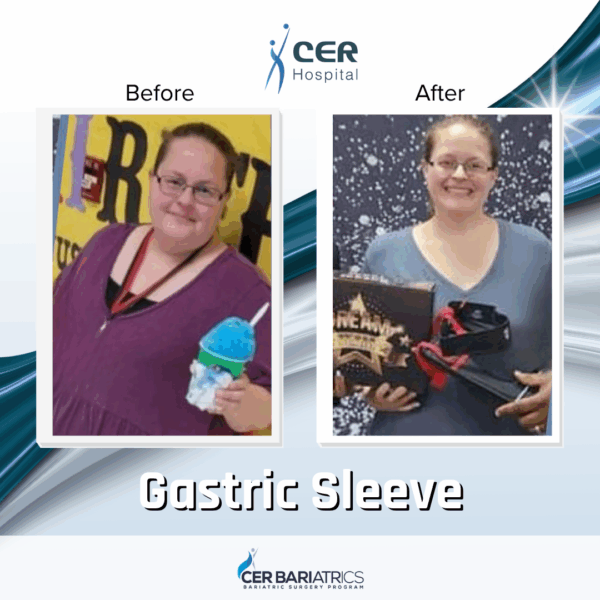 Gastric Sleeve