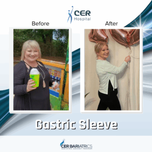 Gastric Sleeve