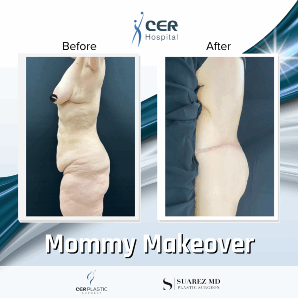 Mommy Makeover - 311 - Image 11
