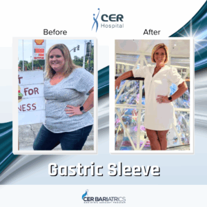 Gastric Sleeve