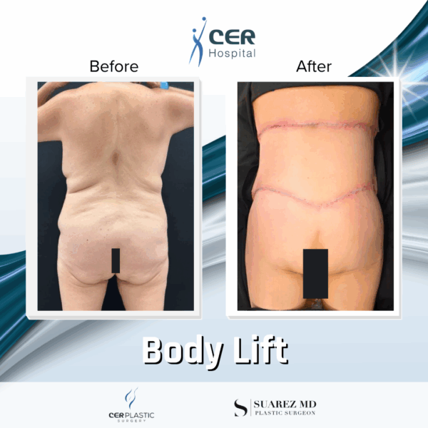 Body Lift - 037 - Image 7
