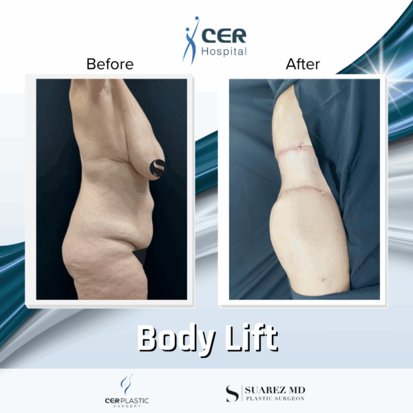 Body Lift -2094 - Image 10