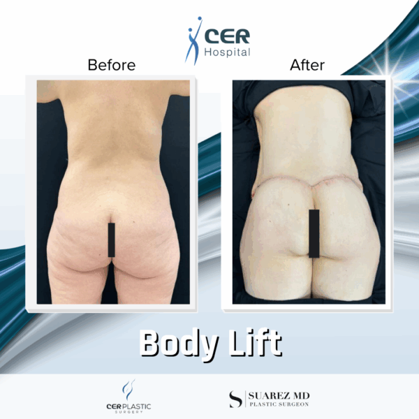 Body Lift - 26064 - Image 9