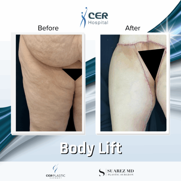 Body Lift - 17064 - Image 9