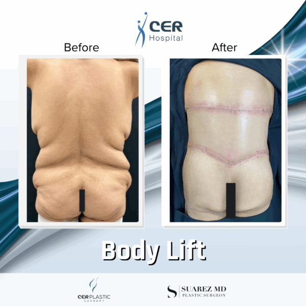 Body Lift -14064 - Image 9