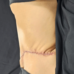 Semi Circular Tummy Tuck – 3064