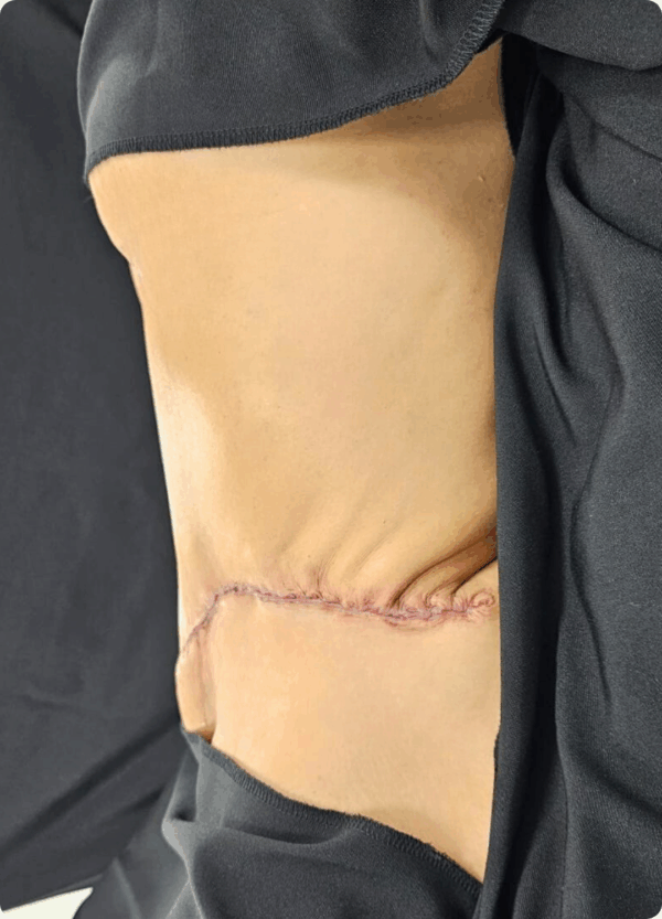 Semi Circular Tummy Tuck - 3064 - Image 2