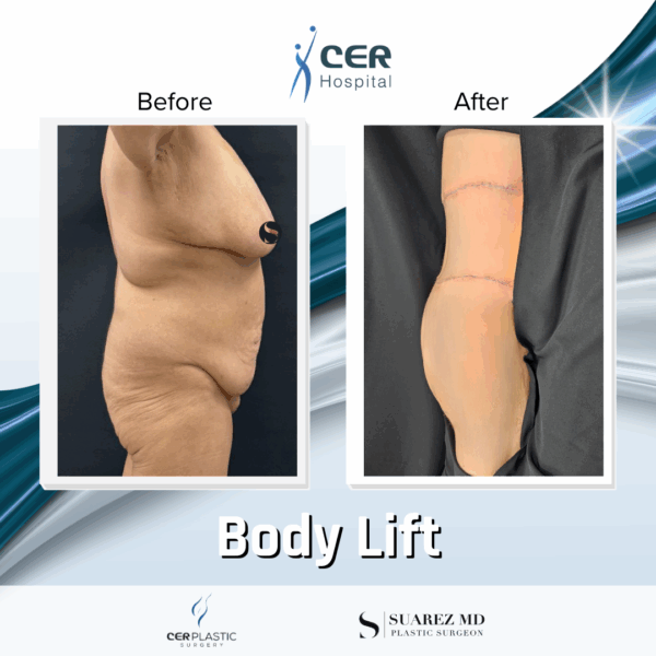 Body Lift - 20054