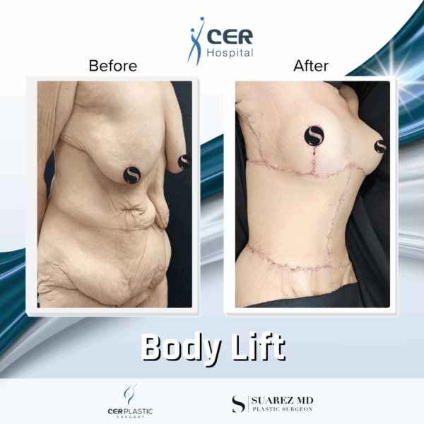 Body Lift - 17054 - Image 9