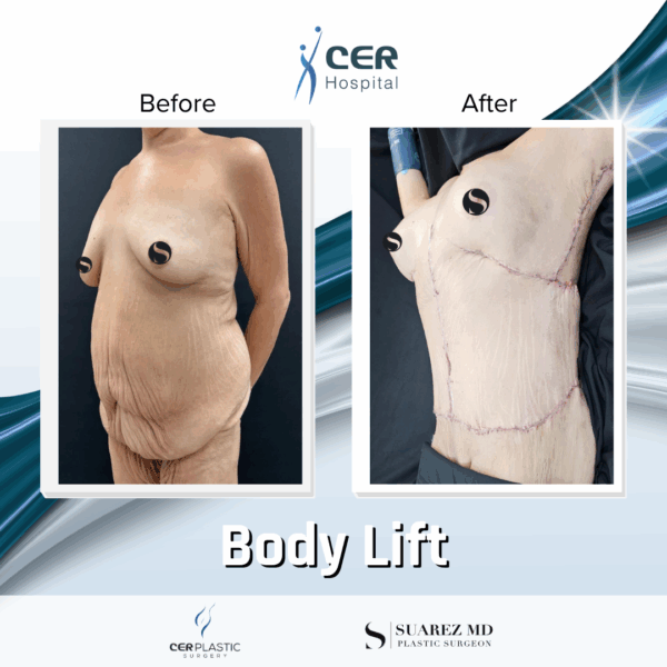 Body Lift - 8054 - Image 10