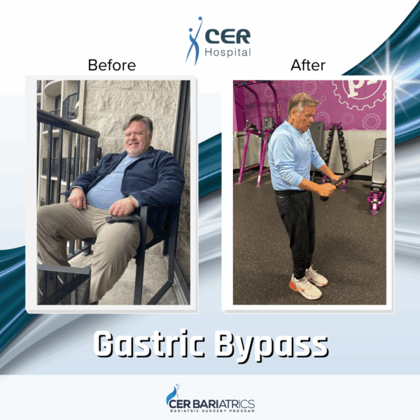 Gastric Bypass - Image 3
