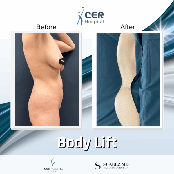 Body Lift - 125 - Image 10