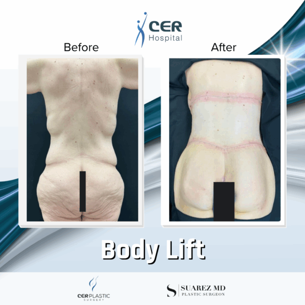 Body Lift - 165 - Image 9