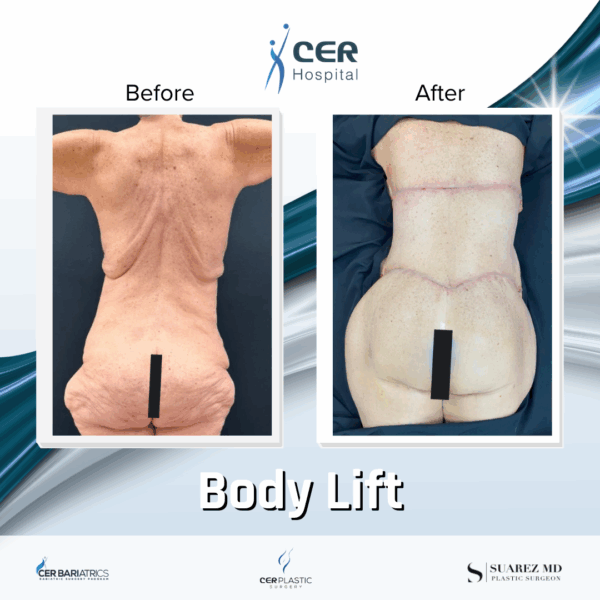 Body Lift - 291 - Image 10