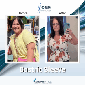 Gastric Sleeve